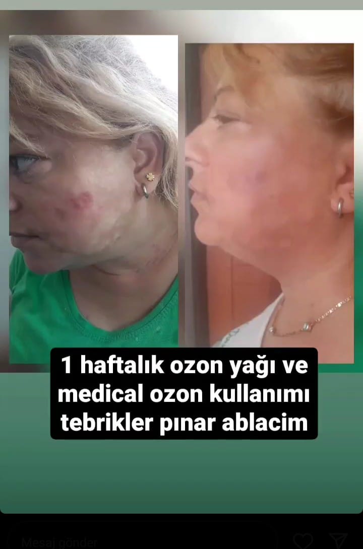 Swans Ozon Yağı Medikal Ozon Şeffaf Şişe 50 Ml